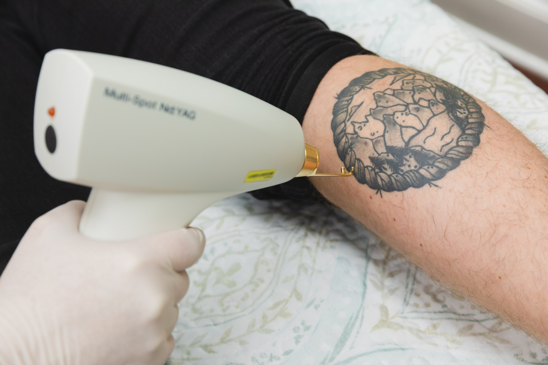 PicoWay: Laser Tattoo Removal in Houston - Ovation Med Spa