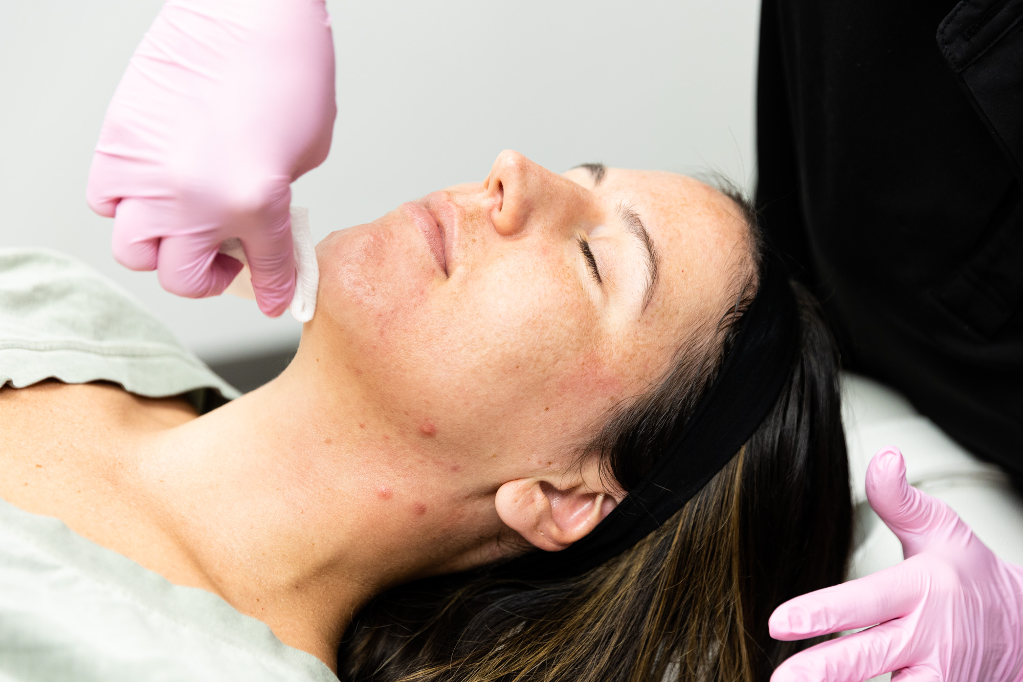 A woman gets a microneedling treatment, a great option for patients looking for a non-surgical facelift in Houston