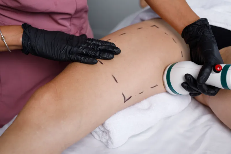 Patient undergoing Onda Coolwaves treatment for fat reduction