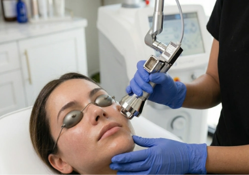 Arctic Laser Peel treatment in progress at Ovation Med Spa