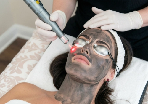 Carbon Laser Peel treatment in progress at Ovation Med Spa