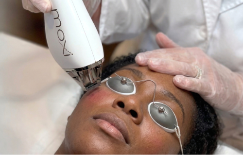 Moxi treatment in progress at Ovation Med Spa